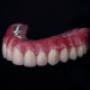 Hybrid denture