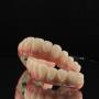 Sm4 ultra hybrid denture