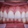 Smile Design After