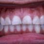 Smile design before
