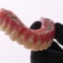 Ultra Hybrid denture over implants