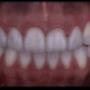 Veneers after smile design