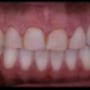 Veneers before smile design