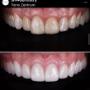 Veneers