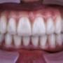 Zirconia crowns over implants