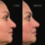 Baby Botox