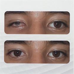 Protesis Oculares, Ojos Artificiales