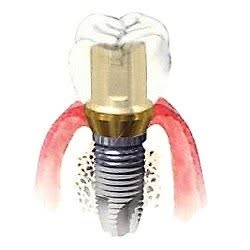 Implantología Oral y Rehabilitación