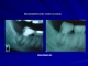 Regeneración Ósea Dental