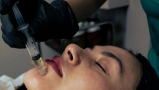 Fillers y Botox