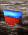 Doppler carotideo