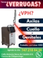 Verrugas Eliminación Láser CO dos